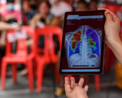 Over 100K tuberculosis cases logged in Metro Manila as of February — DOH